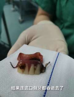 长沙一老人吃药不慎吞假牙卡住食道送医