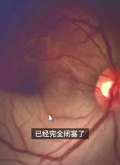 深圳一男子熬夜玩手机险失明,医生:视网膜动脉阻塞引发