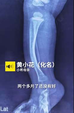 两岁女童患罕见病骨折后无法自愈，妈妈取骨救女
