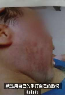 福建泉州一男童的脸被老师打肿 涉事老师仅19岁已被解雇