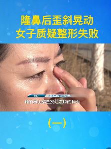 女子隆鼻后歪斜晃动 鼻头发红发肿一碰就痛