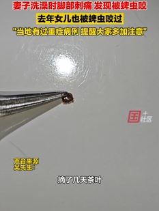 女子曝洗澡时脚部刺痛发现被蜱虫咬