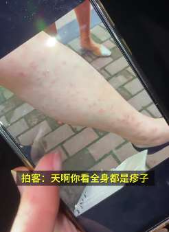 武汉一小区自来水疑遭油漆污染 喝过水的人皮肤过敏全身疹子