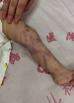 成都一幼童哭闹不止被母亲虐打进ICU