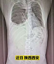 西安一男子醉酒后吞烤肉铁签