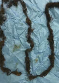 罕见！女子体内取出2米多长头发 医生：从医38年首次见！