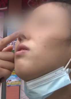 成都一女子隆鼻后发现鼻子不对称 让医院退钱被拒绝