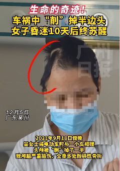 女子车祸被"削"掉半边头奇迹存活