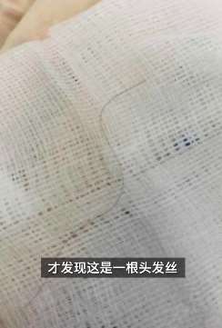 八个月大男婴反复咳嗽7个月 检查后从气道取出10cm头发