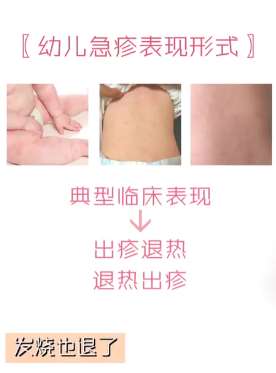 幼儿急疹典型临床表现：出疹退热退热出疹