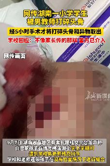 网传湖南长沙一小学学生被男教师打碎头骨