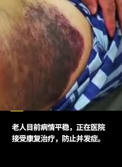 江苏一7旬老人撞树锻炼身体致血管破裂住院