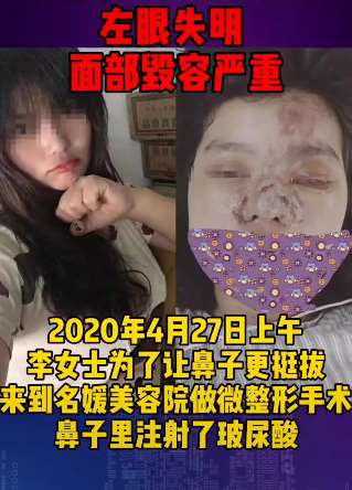 妙龄女子微整形致左眼失明