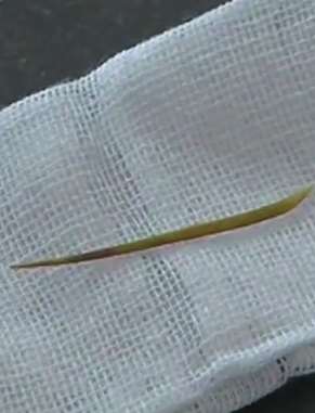 江西一男子从肠道取出4厘米鱼刺，平时卡刺后喝酒吞下去