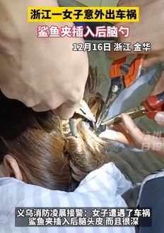浙江一女子出车祸 鲨鱼夹插入后脑勺