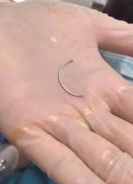 西安一女子产后体内取出2cm缝合针 找医院交涉一直推诿