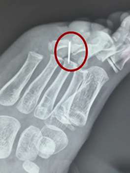 6岁男孩脚掌扎入1cm断针 医生用4小时才取出