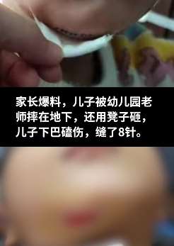 西安一幼童被幼儿园老师摔地上,下巴受伤缝8针!