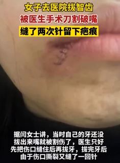 女子医院拔智齿被医生手术刀割破嘴