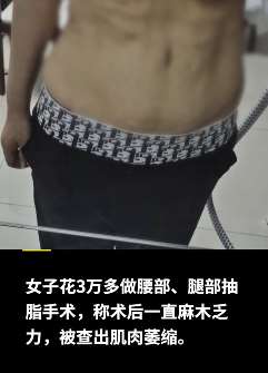 山西一女子花3万做抽脂手术 术后被查出肌肉萎缩