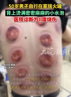男子自行在家拔火罐 背上烫满小水泡