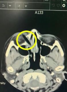 女子骑电动车不慎摔倒 5.5cm长树枝戳入眼睛