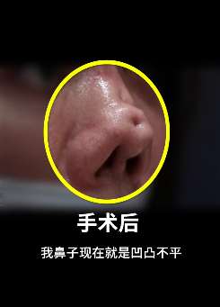 90后女主播做隆鼻修复手术后面目全非