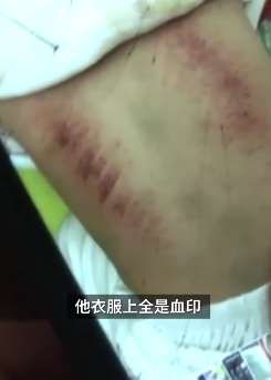 1岁幼童洗药浴治感冒背部长满血斑