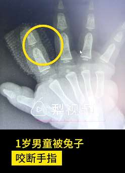 东莞一男童被兔子咬断手指，因断指丢失仅将伤口缝合