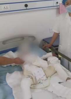 湖南一家3口吃饭被火锅燃料烧伤