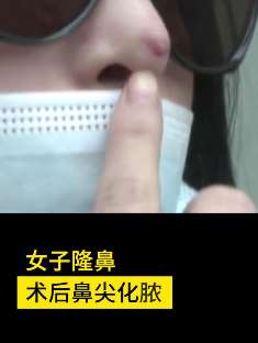 重庆一女子花近5万元隆鼻后化脓溃烂