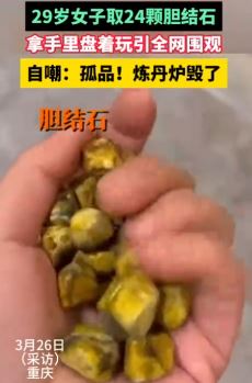 重庆一29岁女子取24颗胆结石盘着玩引全网围观