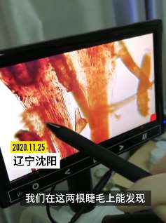 警惕螨虫性睑缘炎！一患者睫毛存18只螨虫，酒精泡2小时不死