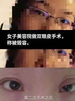 兰州一女子割双眼皮后眼睛一大一小 涉事医院:可以去告!