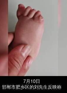 河北邯郸一幼儿小脚趾畸形 医生手术失误致截肢