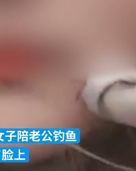 南京一女子陪老公钓鱼意外被鱼钩钩脸上