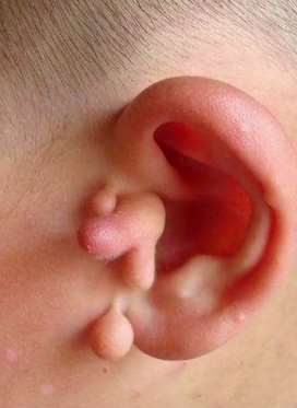 耳朵旁的是小疙瘩是什么？能否切除？答案就在这里！