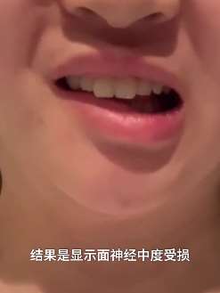 深圳一女子在整形医院做脸部抽脂后嘴巴变歪