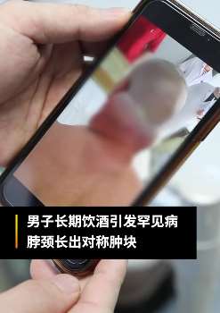 福建一男子长期酗酒患罕见病 身形似“绿巨人”
