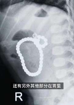 江苏一女童吞食40颗磁力珠险丧命