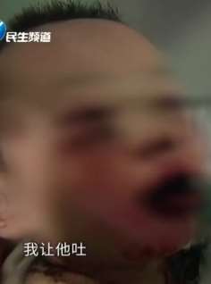 2岁男孩误食管道疏通剂嘴巴被严重腐蚀