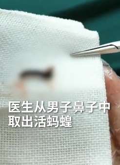 广西一男子鼻子内取出活蚂蝗 曾在野外喝过山泉水