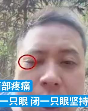 民警进山侦办案件被马蜂蜇伤面部 忍痛坚持完成任务