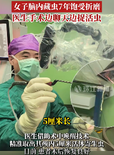 女子脑内藏虫7年饱受折磨 医生取出一5cm长活体寄生虫