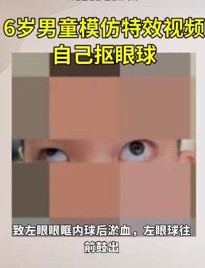 浙江6岁男童模仿特效抠眼球 致左眼球往前鼓出