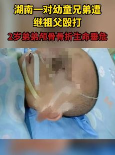 湖南一对幼童兄弟遭继祖父殴打