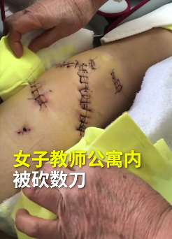 太原一女教师被前同事弟弟连砍数刀留一身伤疤
