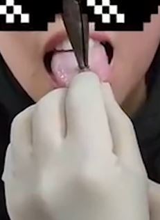 信阳一女孩舌钉卡舌疼痛难忍求助消防员