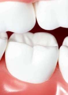 牙垢不用花钱去清洗，用这个方法去试一试，牙垢可以轻松清理干净