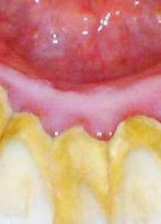 夏天牙齿发黄口臭，教您成本不到1块钱，告别牙黄，拥有清新口气